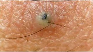 Unusual types of Cysts Eruptive Vellus Hair Cysts this week [upl. by Amye]