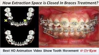 How Extracted Premolars Space is Closed by Braces Best Animation to Know Sliding Mechanics Dr Ram [upl. by Garrik458]