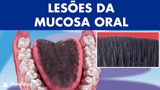 Leucoplasia língua geográfica líquen plano e outras lesões da mucosa oral © [upl. by Estus]