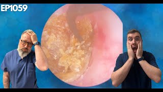 REMOVING THE MOST IMPACTED EAR WAX EVER  EP1059 [upl. by Rehpotsrik]