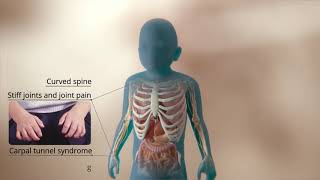 An Inside look at Mucopolysaccharidosis Type I MPS I [upl. by Aleirbag]