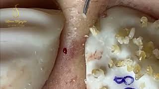 Loan Nguyen Acne Treatment 408pre [upl. by Nomahs]