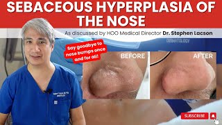 DERMATOLOGIST EXPLAINS HOW TO TREAT NOSE BUMPS DUE TO SEBACEOUS HYPERPLASIA [upl. by Emmeram]