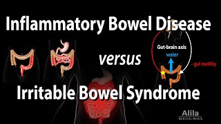 Inflammatory Bowel Disease vs Irritable Bowel Syndrome Animation [upl. by Christabel]