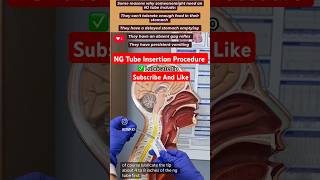 NG Tube Insertion Procedure Emergency icu pharmacynursingdoctor [upl. by Ecyned]