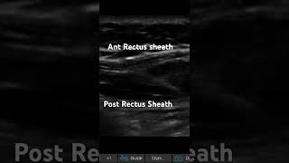 RECTUS SHEATH BLOCK IN LONG AXIS [upl. by Caras]