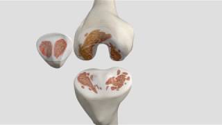 Total Knee Replacement Patient Animation [upl. by Maupin]