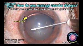 CataractCoach™ 2083 Cataract Quiz how do you manage zonular dialysis [upl. by Ruiz]