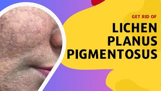 Get Rid of Lichen Planus Pigmentosus [upl. by Coke]