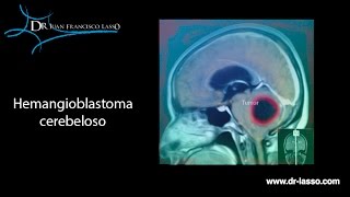 Hemangioblastoma cerebeloso [upl. by Naitsabas]