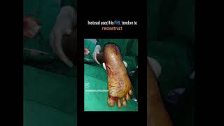 Achilles tendon reconstruction  FHL tendon transfer [upl. by Nniuq]