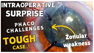 Intraoperative surprises and Phaco challenges in an eye with zonular weakness quotTough Casequot [upl. by Reamy]