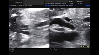 diverticolo centimetrico coledocico tipo II [upl. by Odlanir]