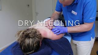 Dry Needling bij Fitaal Fysiotherapie Heerenveen [upl. by Hoeg]