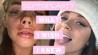 How To Survive A Septoplasty  What I Wish I Knew [upl. by Marigold814]