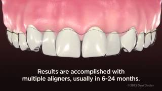 ClearPath Aligners  NEW VIDEO for PATIENT EDUCATION by AACD [upl. by Enneles]