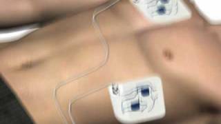 How to use an AED automated external defibrillator [upl. by Malcom380]