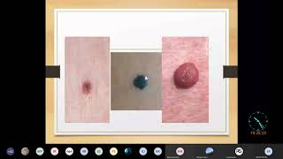 Nevus  Skin Pathology Complete  MBBS Lecture [upl. by Namyh401]