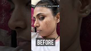 How to use Tretinoin Cream for most effective results Tretinoin before and after skin ✨shots [upl. by Spillihp]