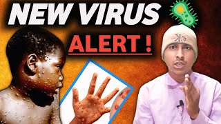 Monkey Pox Virus A Growing Public Health Threat  Explain Video  Vivek Bind [upl. by Enegue]