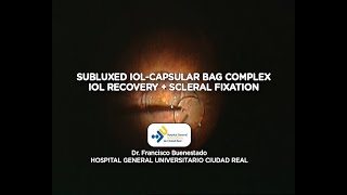 Subluxed IOLcapsular bag complex [upl. by Zinn]