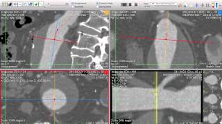 EVAR Planning  Centerline for Aortic amp Total Length  How I do it with Osirix [upl. by Gnilhsa633]