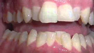 Limited Orthodontic Treatment of Lower Front Teeth [upl. by Vania]