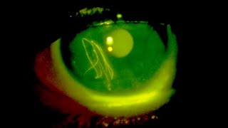 Fluorescein eye stain [upl. by Oniuqa]