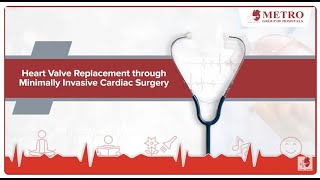 Patient Success Story  Mitral valve stenosis  Dr Jeewan Pillai  Metro Hospital Noida [upl. by Eirellam74]