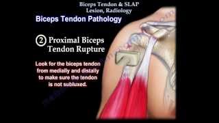 Biceps Tendon amp SLAP Lesion Radiology  Everything You Need To Know  Dr Nabil Ebraheim [upl. by Helban210]