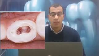 البيدو pulpotomy ولا pulpectomy [upl. by Vil]