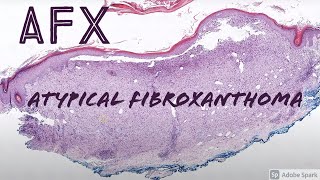 AFX atypical fibroxanthoma  dermpath dermatology pathology dermatopathology [upl. by Rodoeht]