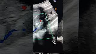 Renal Mass ultrasound abdomenangiomyolipomabening lesion [upl. by Haleeuqa]