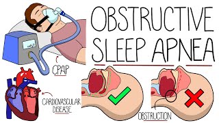 Understanding Obstructive Sleep Apnea Syndrome [upl. by Nerissa]