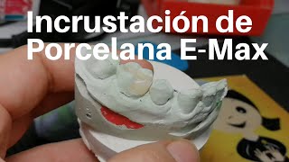 INCRUSTACIÓN Dental de Porcelana👅 EMax Onlay dentaltip [upl. by Dlonyar]