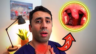 What Causes a Sore Throat HOME Remedies and Cures for Fast TREATMENT Doctor Explains [upl. by Ocire]