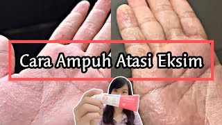 AKHIRNYA NEMU SKINCARE YANG AMPUH ATASI EKSIMKU‼️  EKSIM DISHIDROSIS  POMPHOLYX [upl. by Honora]