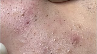 Acne treatment for Spa Linh Mun 2023 003 [upl. by Alrep508]