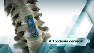 Artrodesis cervical [upl. by Adiahs]