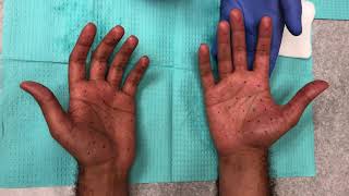 Botox palm injections for hand sweating hyperhidrosis [upl. by Creighton938]