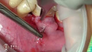 Modified Lateral Pedicle Flap for Augmentation of Keratinized Gingiva at Mandibular Molar IV [upl. by Notanhoj]