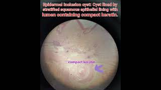 Epidermal inclusion cysthistologyskinpathologymedical [upl. by Rimidalb]