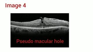 OCT MACULA Image quiz with explanation  Optometry Tamil  Made easy [upl. by Kalvn613]