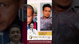 Hair Transplant Results in Chandigarh  Dr Rahul Goyal  Chandigarh Hair Transplant shortsvideo [upl. by Artied]