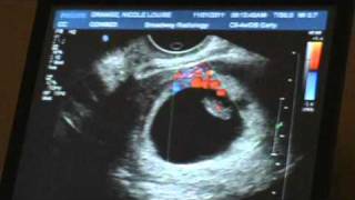 Ultrasound  7weeks 5 days Pregnant [upl. by Martine]