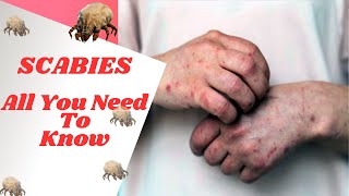 How To Identify amp Treat Scabies Causes Symptoms Prevention  Permethrin Ivermectin [upl. by Yaakov]