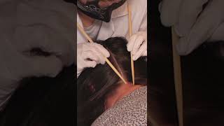 ASMR Examining Skin LESIONS on SCALP Real Person hair asmr short shorts [upl. by Branham]