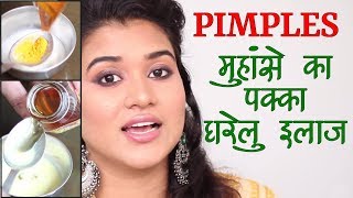 Home Remedies for Pimples  Acne Hindi [upl. by Elmira983]