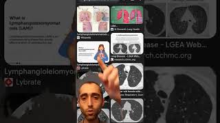 Radiology and pulmonology  Lymphangioleiomyomatosis LAM [upl. by Llenyaj]