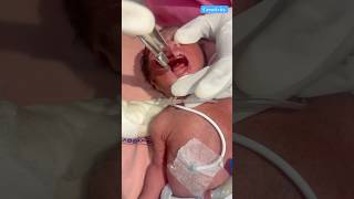 Et Tube Insertion medical nicu newbornbaby [upl. by Llenral]